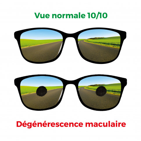 Lunettes simulant la dégénérescence maculaire à 6/120