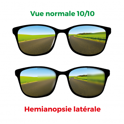 Lunettes simulant l'hémianopsie latérale