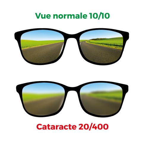 Brille zur Simulation von Katarakten